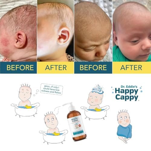 Best Baby Shampoo For Cradle Cap